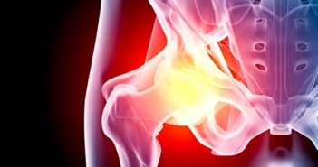 Comment Soulager les Douleurs Liées à l’Arthrose Arthrose de la Hanche